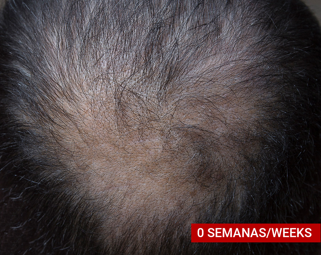 Hair Loss Treatment | Estado inicial