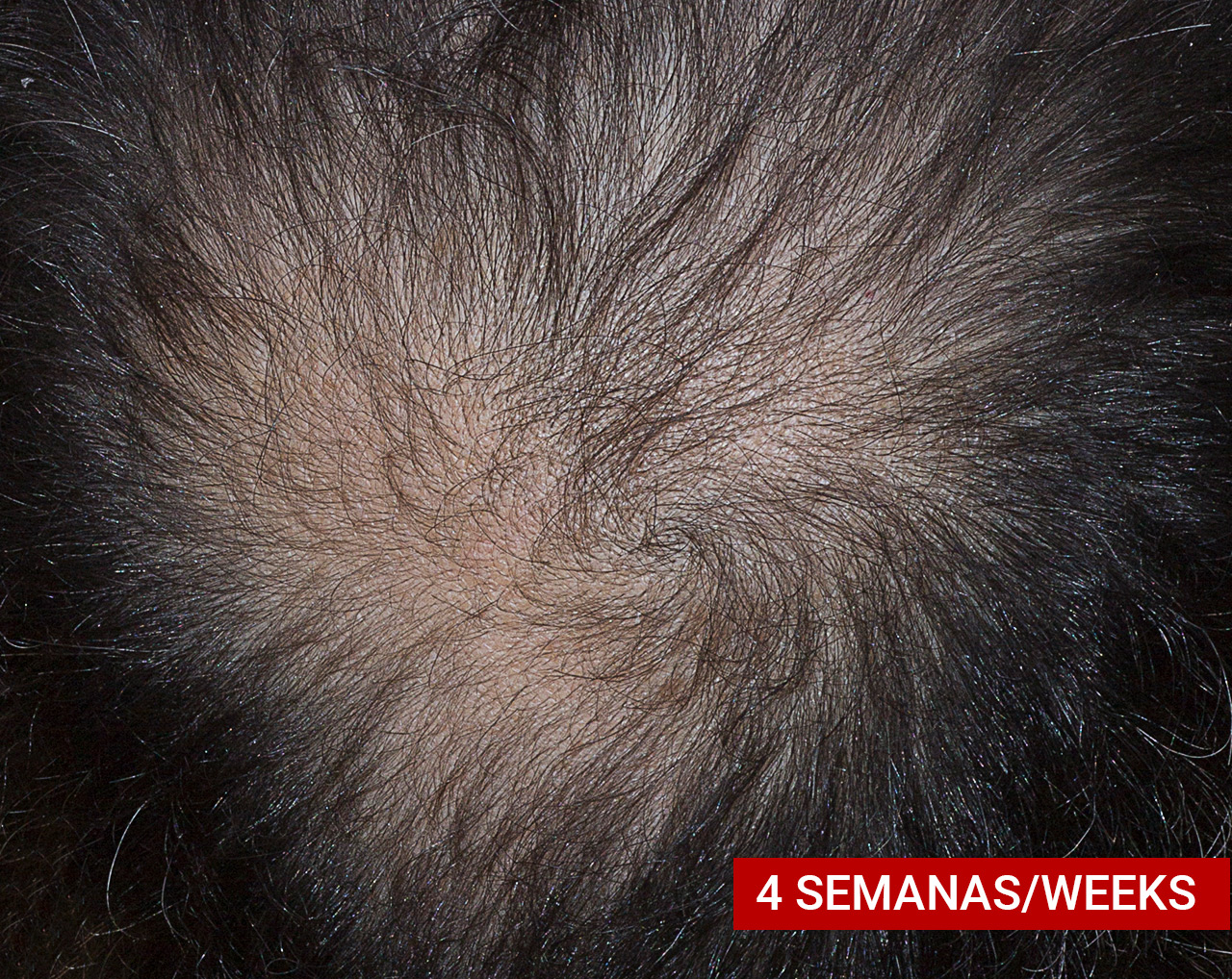 Hair Loss Treatment | Resultado a las 4 semanas