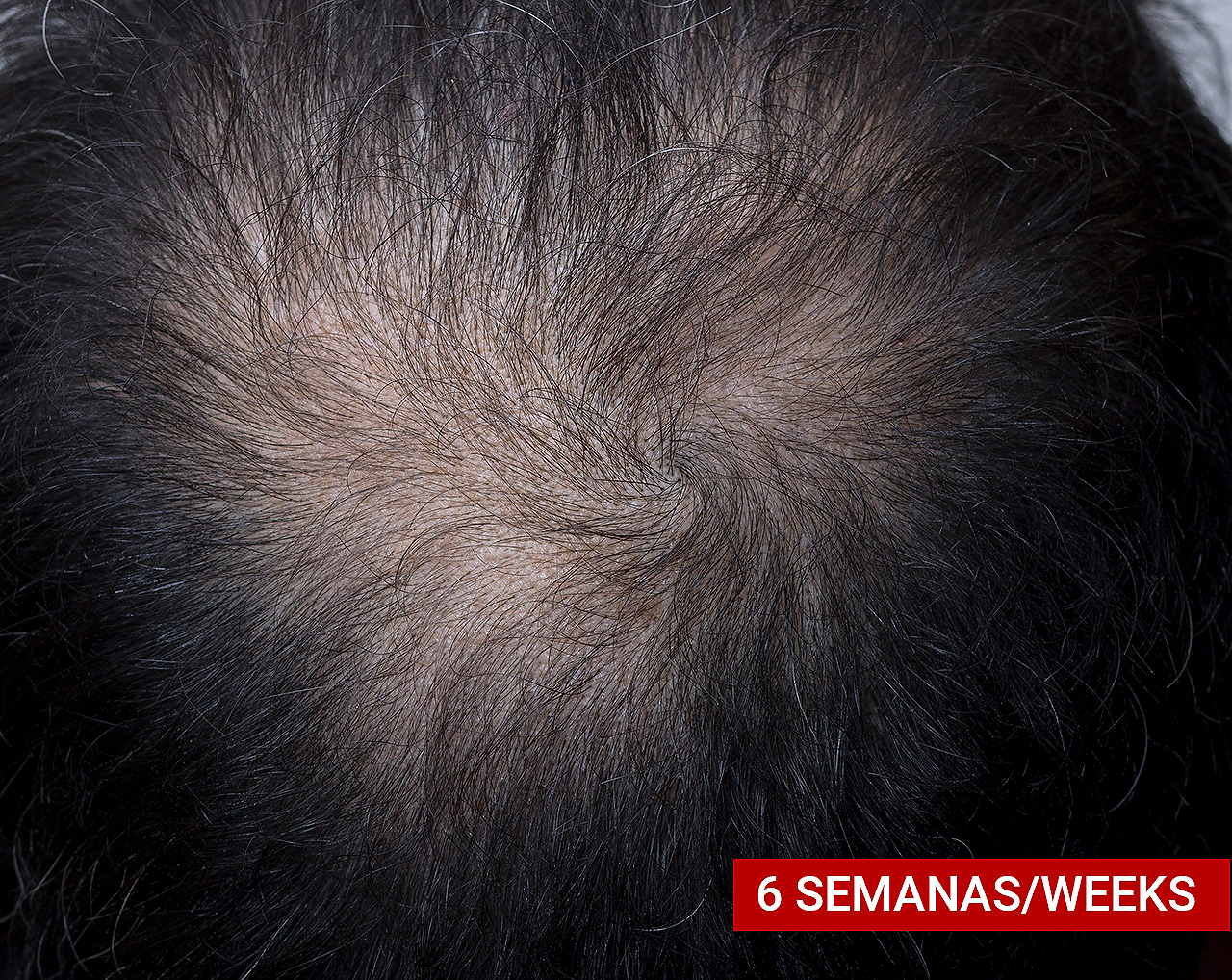 Hair Loss Treatment | Resultado a las 6 semanas
